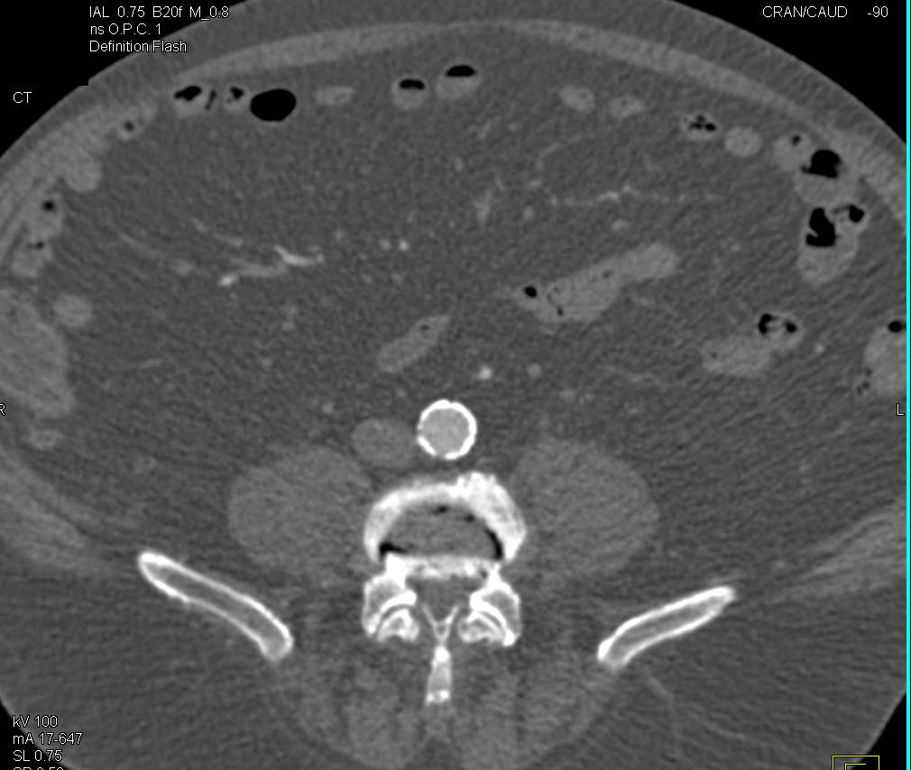 CTA Runoff with Peripheral Vascular Disease (PVD) - CTisus CT Scan