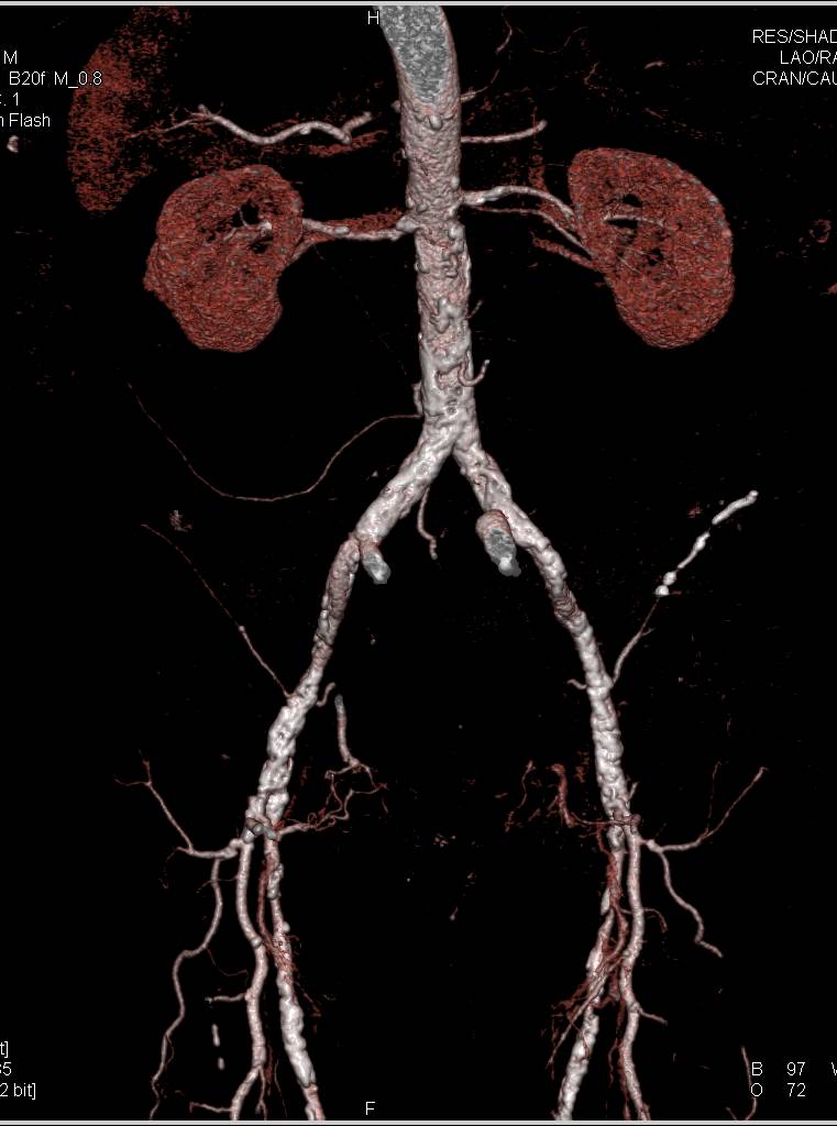 CTA Runoff with Peripheral Vascular Disease (PVD) and Stenosis - CTisus CT Scan