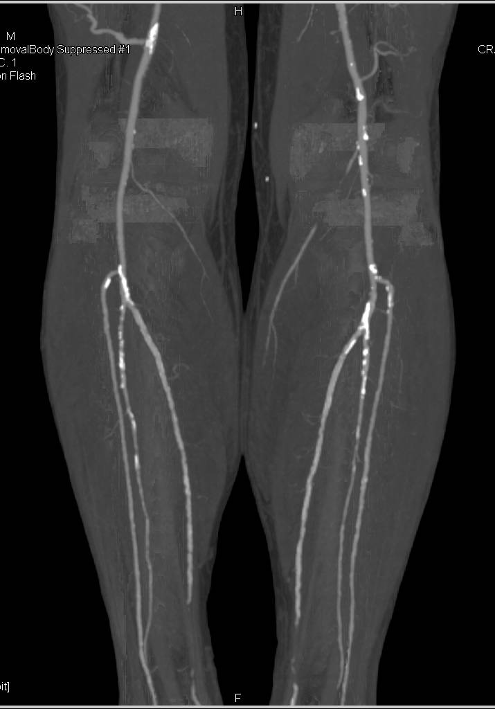 Runoff with Mild Peripheral Vascular Disease - CTisus CT Scan