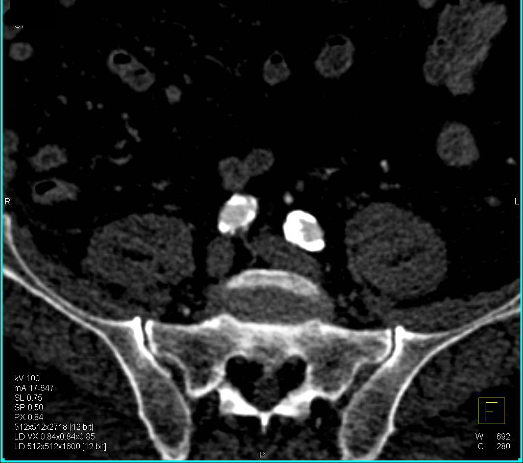 Severe Vascular Disease in Superficial Femoral Artery (SFA) - CTisus CT Scan