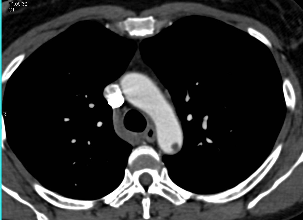 Multiple Thrombi in the Arterial Tree - CTisus CT Scan