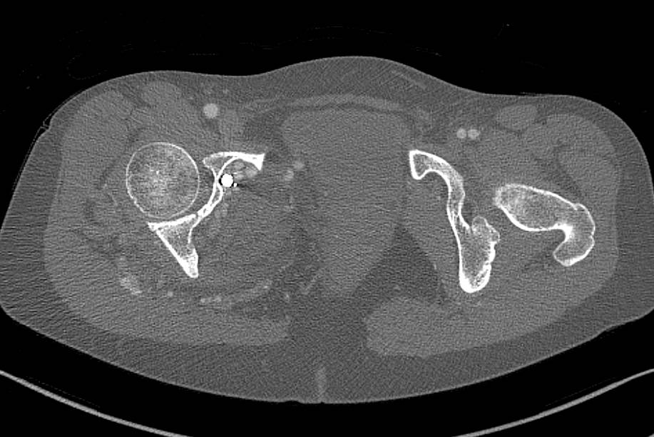 Arteriovenous Malformation (AVM) Pelvis with Prior Embolization - CTisus CT Scan