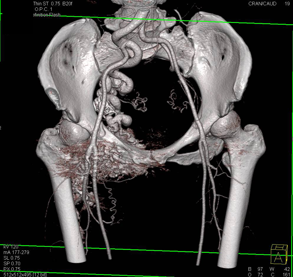 Right Pelvic Arteriovenous Malformation (AVM) with Prior Embolization - CTisus CT Scan