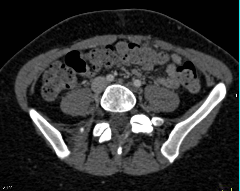 Deep Vein Thrombosis (DVT) Left External Iliac Vein and Femoral Vein - CTisus CT Scan