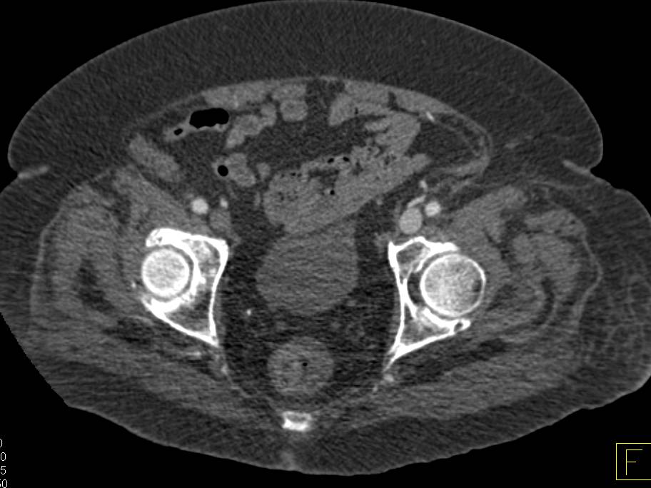 Pseudoaneurysm Left Groin with Arteriovenous (AV) Fistulae Best Seen on 3D Images - CTisus CT Scan