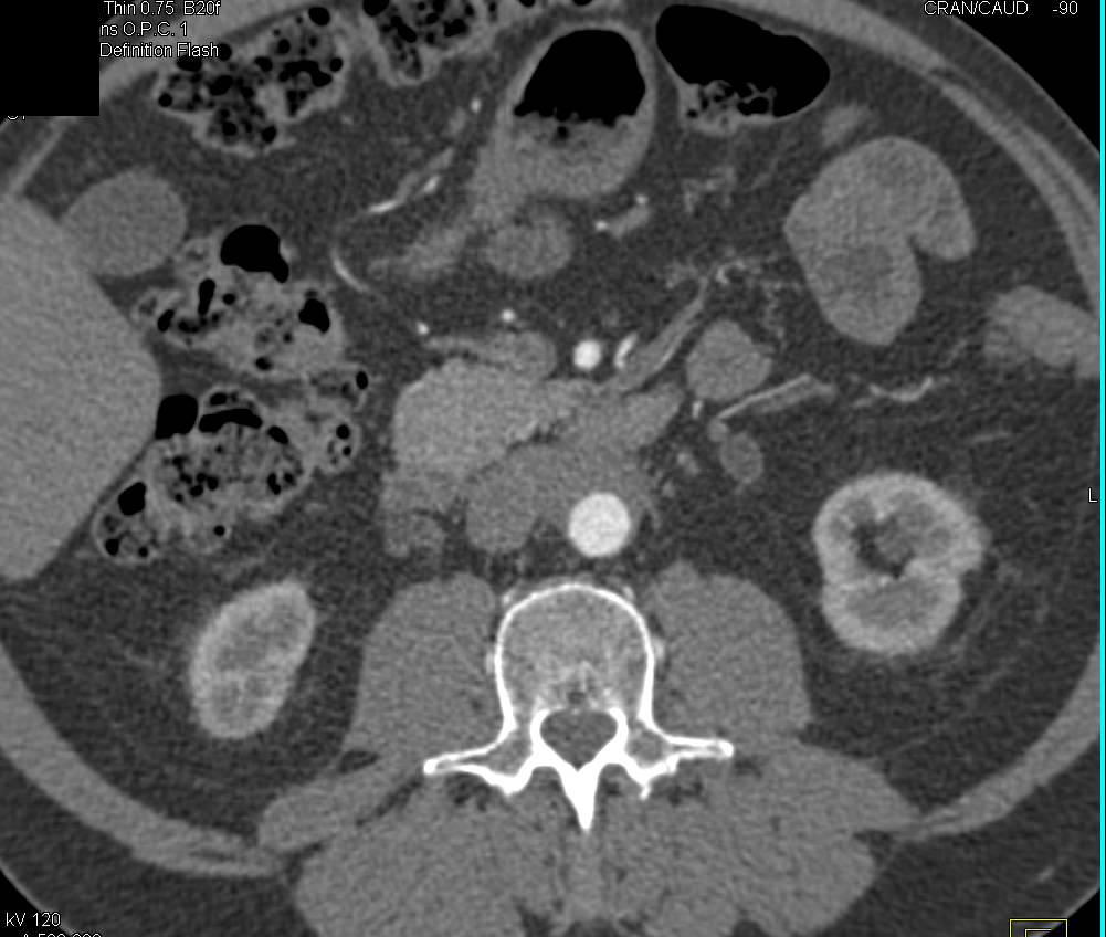 Retroperitoneal Fibrosis Encases the Aorta Nicely Shown in 3D - CTisus CT Scan