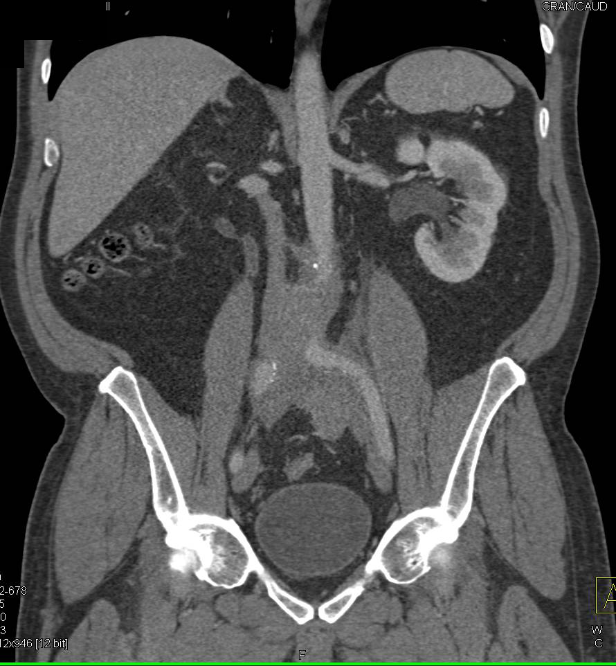 Retroperitoneal Fibrosis Encases the Aorta and Iliac Arteries - CTisus CT Scan