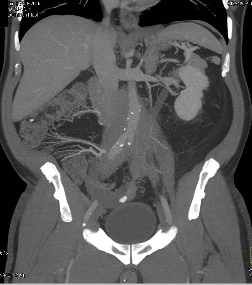 Retroperitoneal Fibrosis Encases the Aorta and the Iliac Arteries - CTisus CT Scan