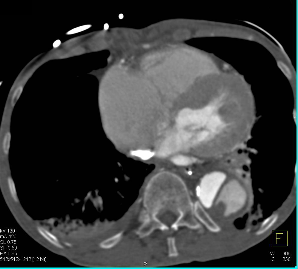 Type B Dissection with Ulcerations - CTisus CT Scan