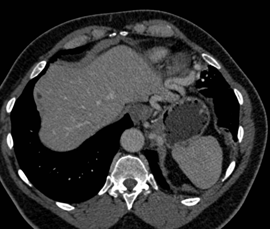 Splenic Artery Aneurysm - CTisus CT Scan