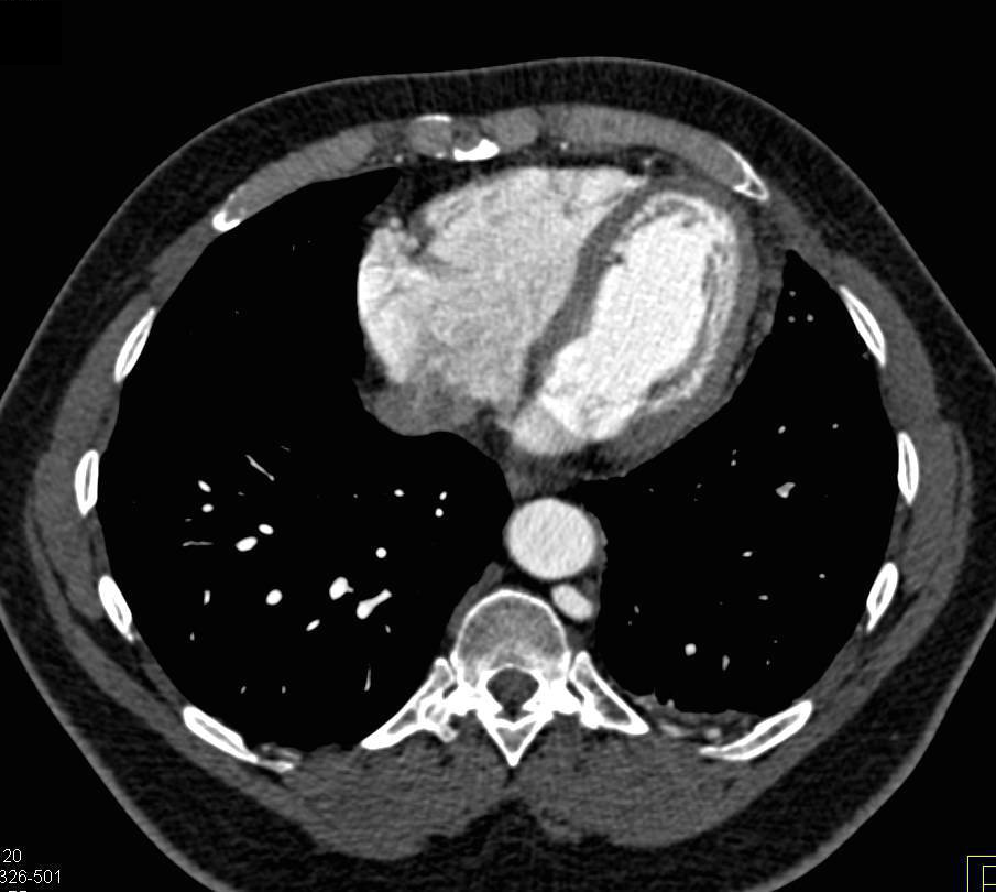 Dissection in Celiac Artery and Splenic Artery Aneurysm - CTisus CT Scan