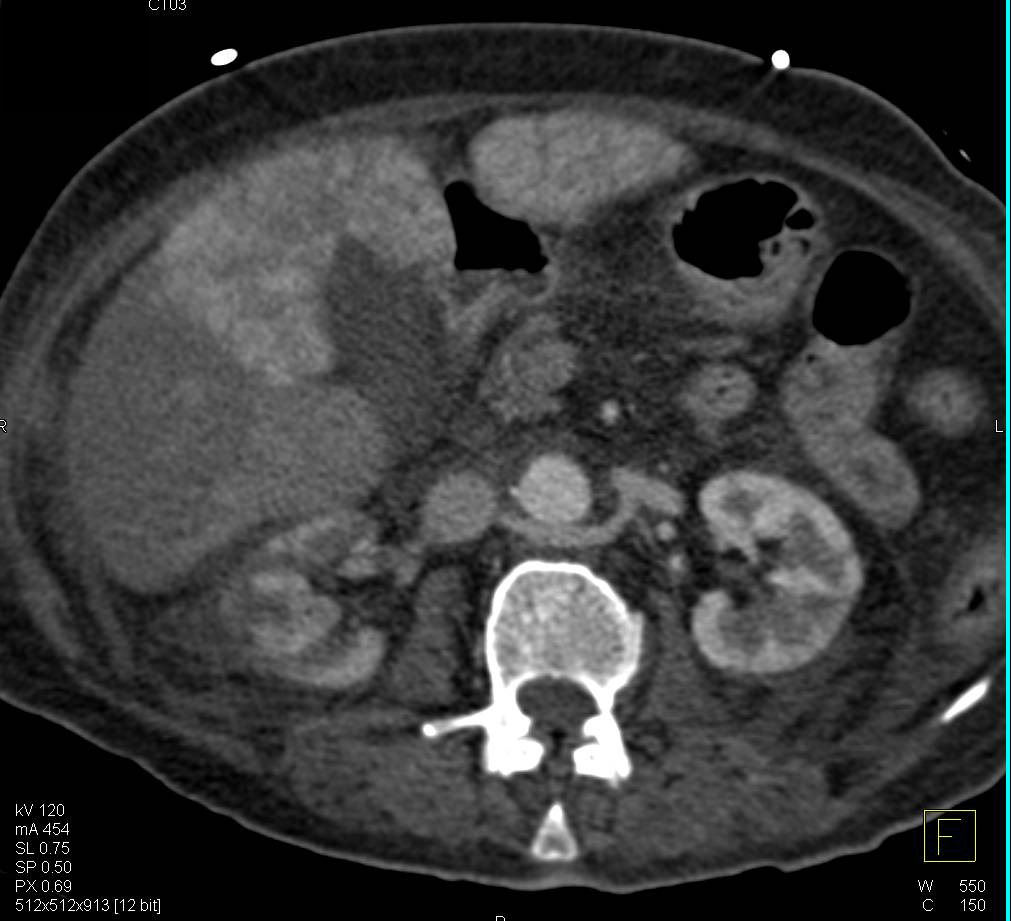 Renal and Hepatic Infarcts - CTisus CT Scan