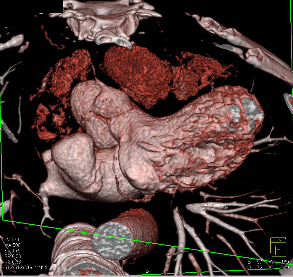 Atrial Septal Defect on Cardiac CTA - CTisus CT Scan