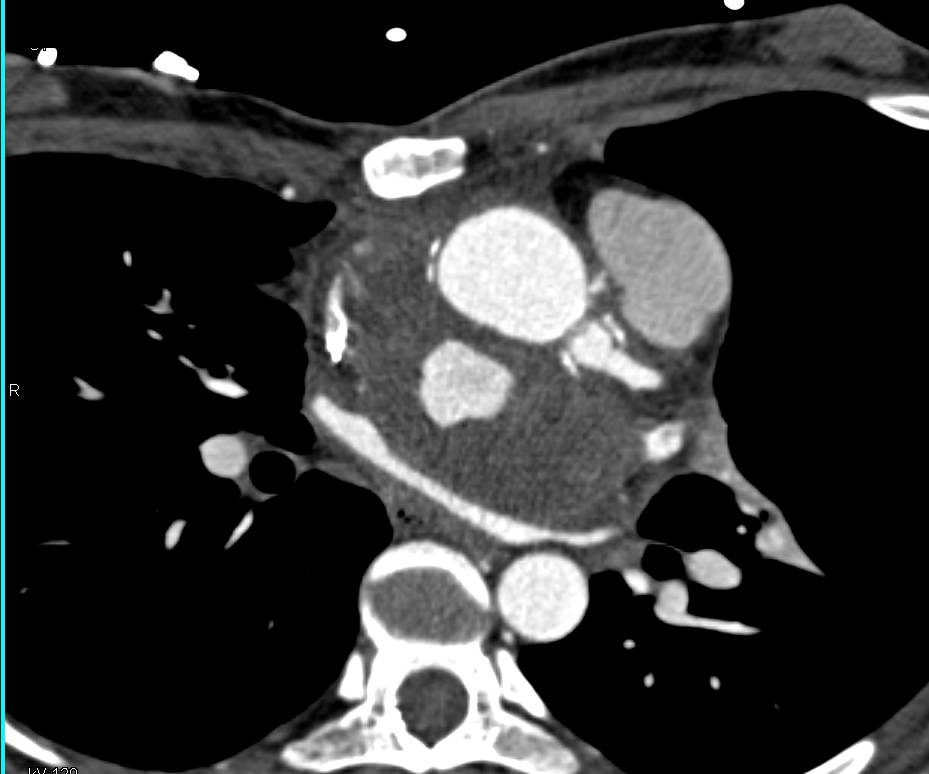 Dilated Aorta S/P Repair with No Leak - CTisus CT Scan