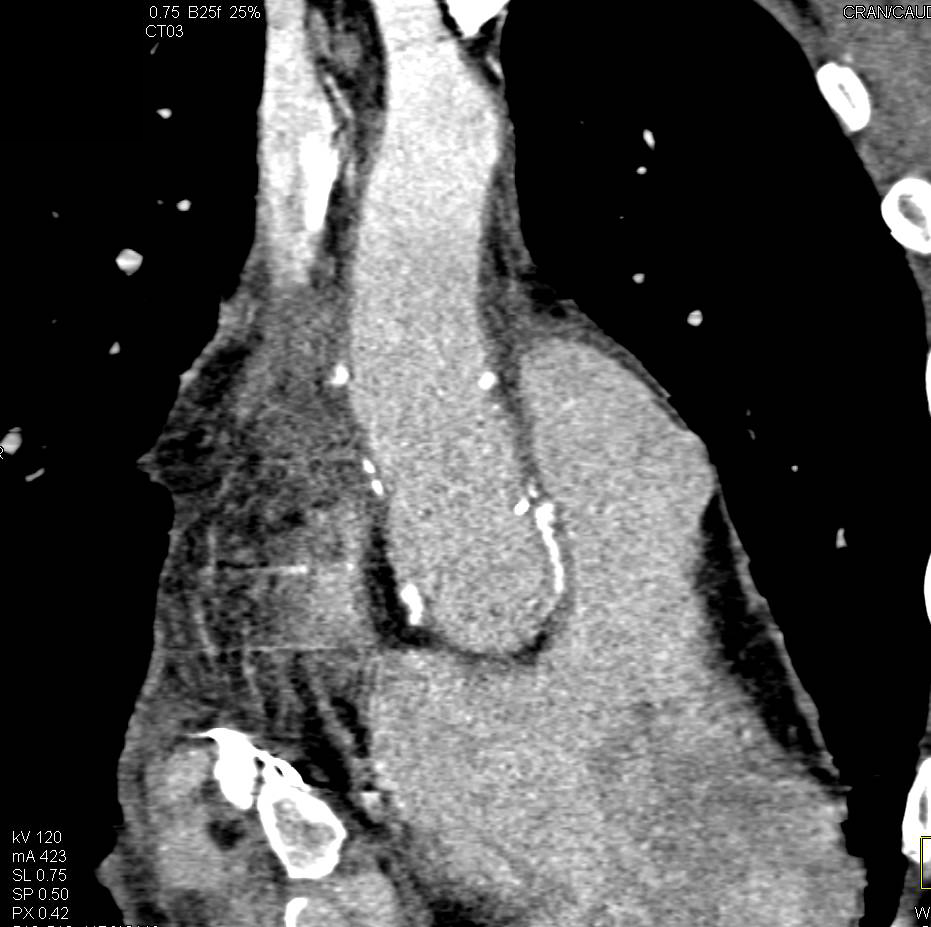 Pseudoaneurysm off the Aortic Root - CTisus CT Scan