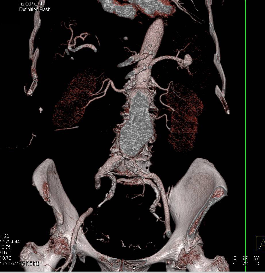 Abdominal Aortic Aneurysm with Diseased but Patent Celiac and SMA - CTisus CT Scan