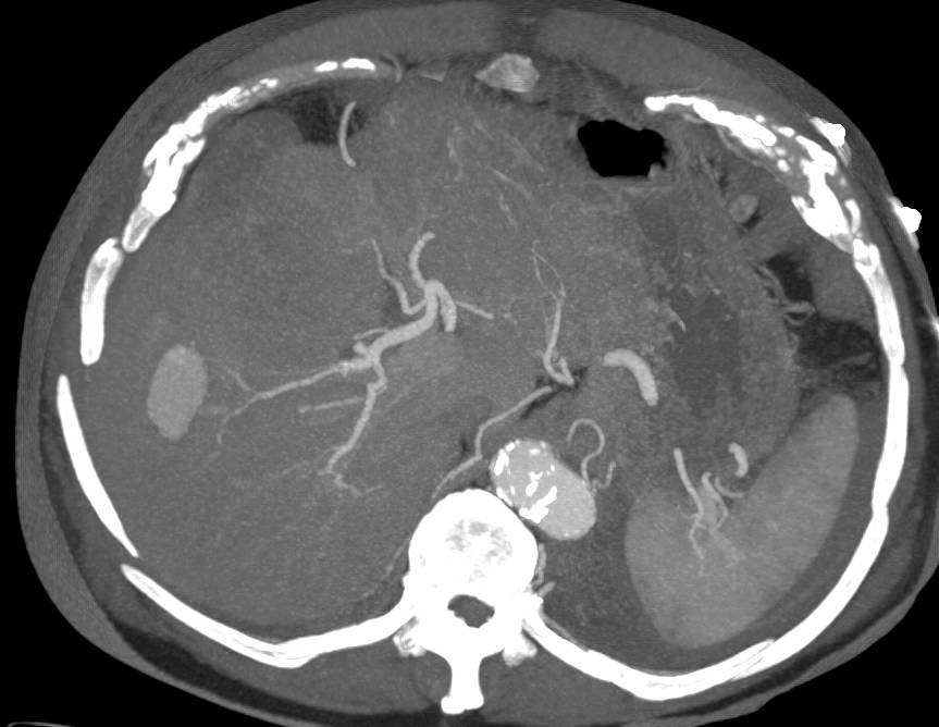 Hepatic Artery Pseudoaneurysm - CTisus CT Scan