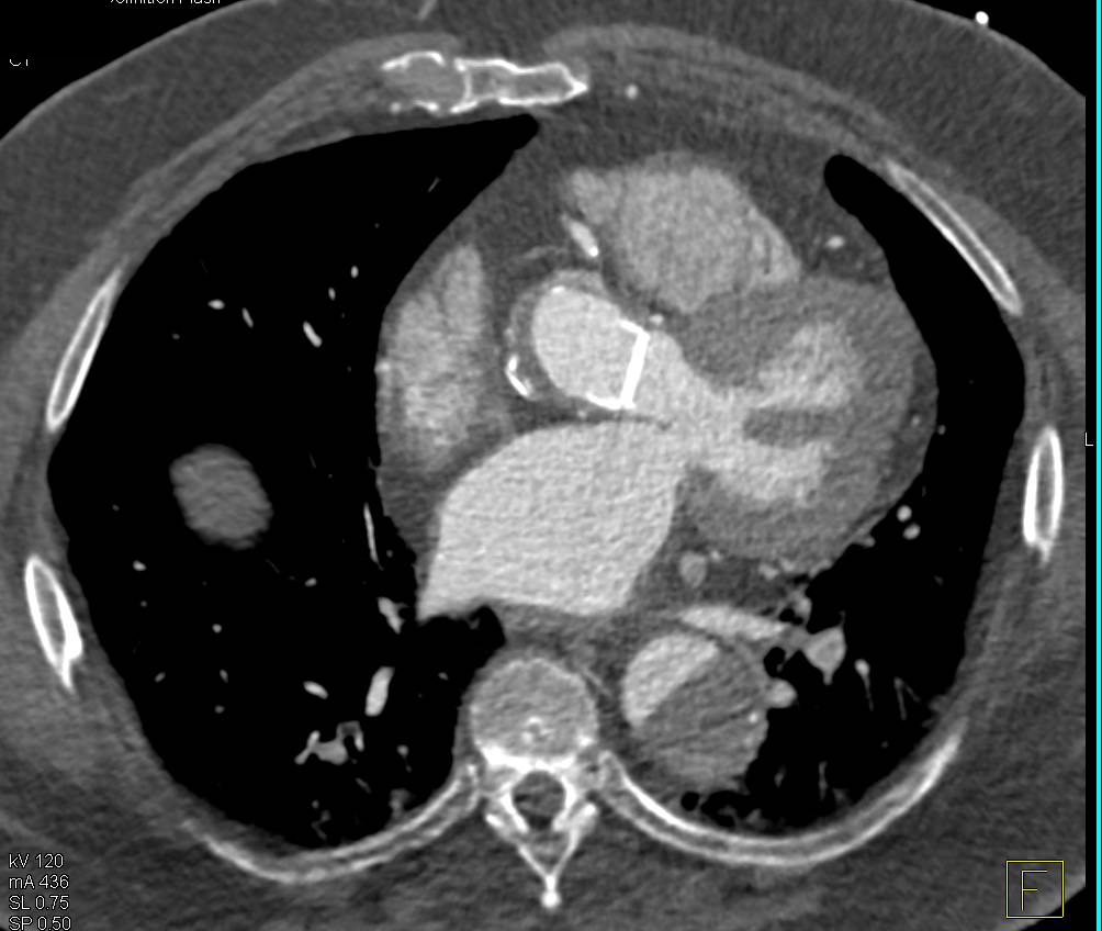 Type A Dissection Involves Right Subclavian Artery - CTisus CT Scan