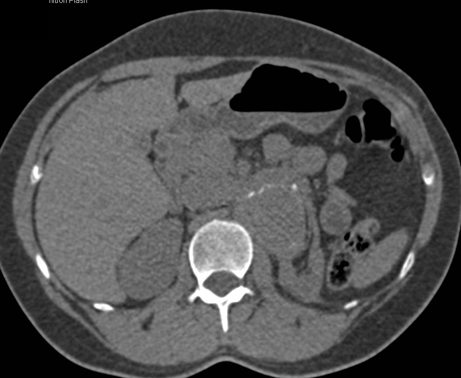 Reimplanted Right Renal Artery - CTisus CT Scan