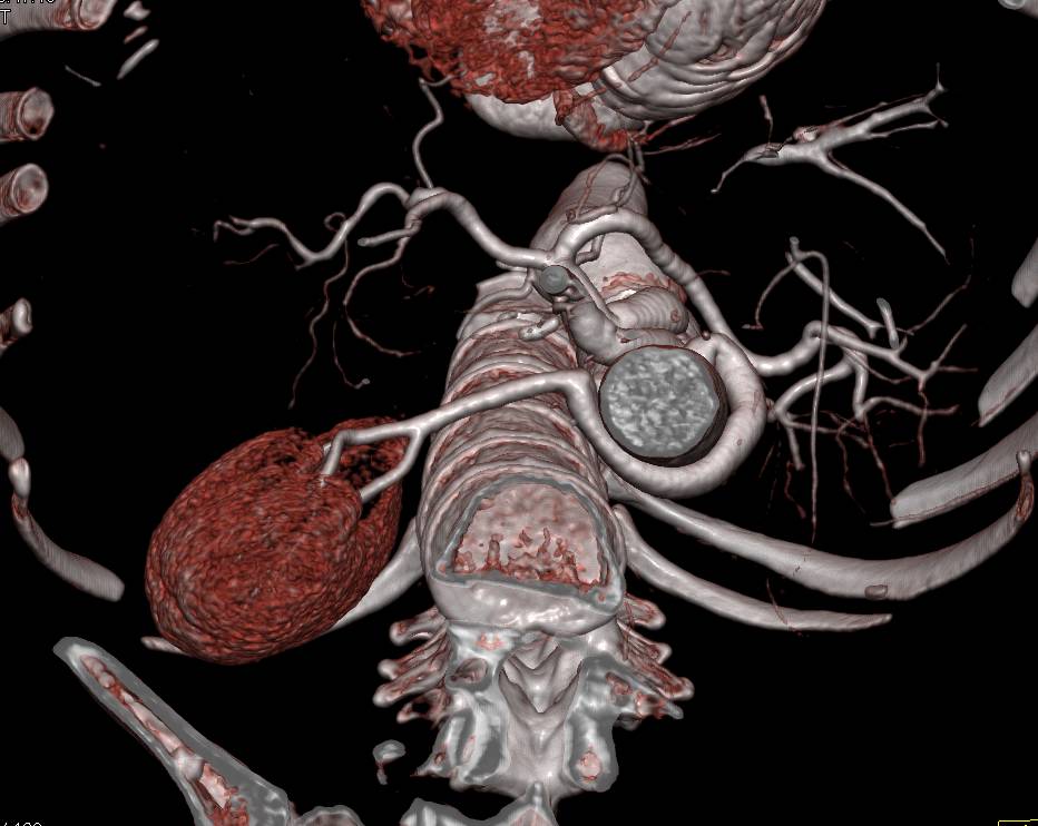 Incedible Reimplanted Right Renal Artery - CTisus CT Scan