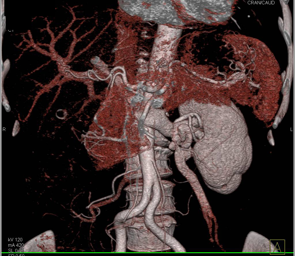 Dilated Left Gonadal Vein - CTisus CT Scan