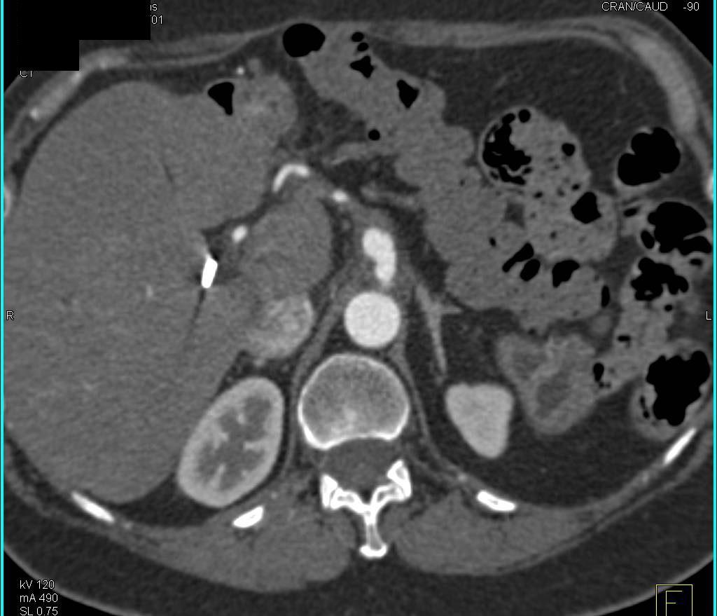 Celiac Artery Aneurysm - CTisus CT Scan