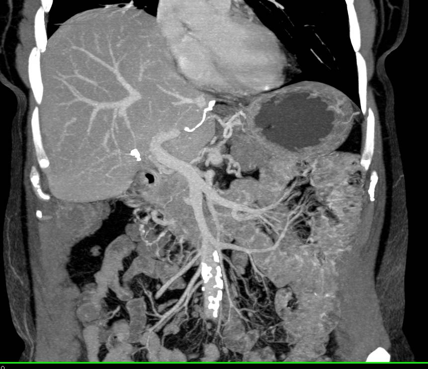 Complex Vascular Disease with Fibromuscular Dysplasia (FMD) Right Renal Artery, Celiac Aneurysm, and Superior Mesenteric Artery (SMA) Stenosis - CTisus CT Scan