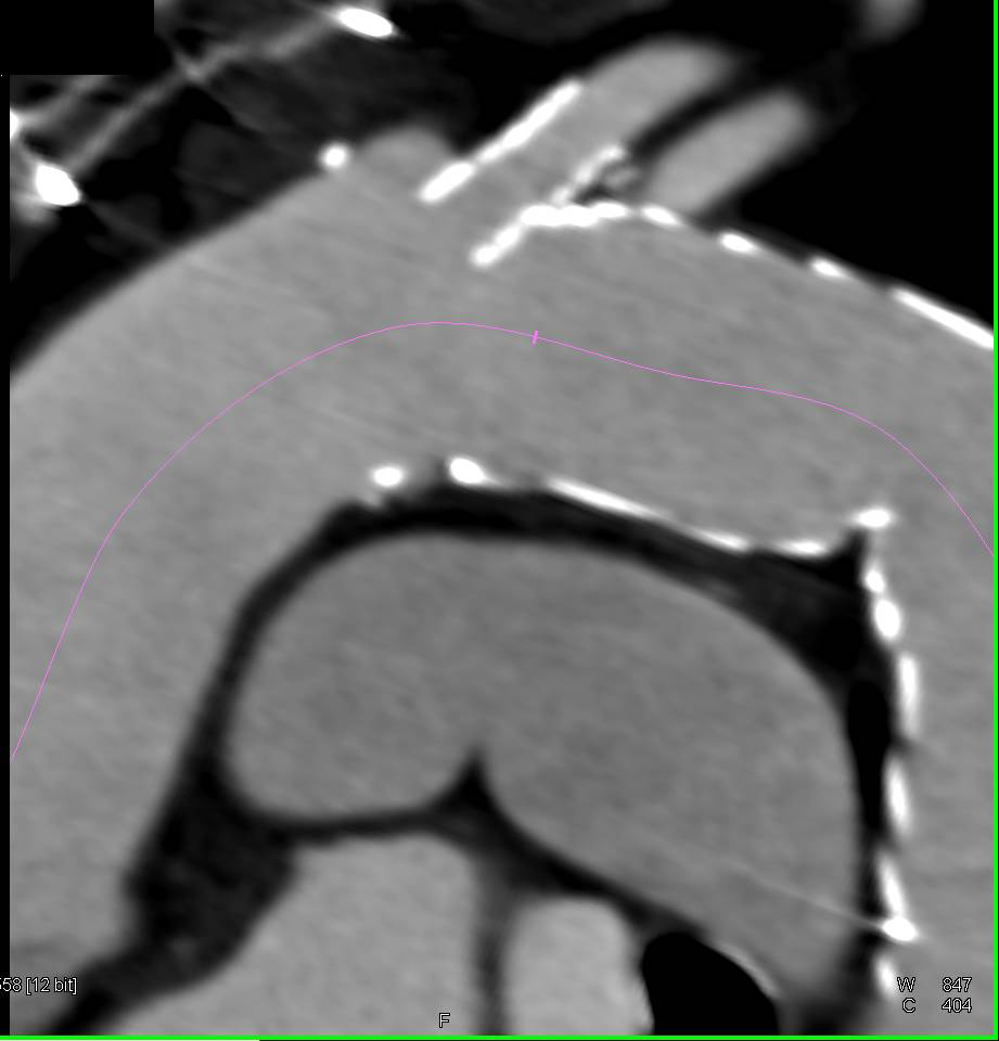 Endovascular Stent in Thoracic Aorta for Aneurysm Repair - CTisus CT Scan