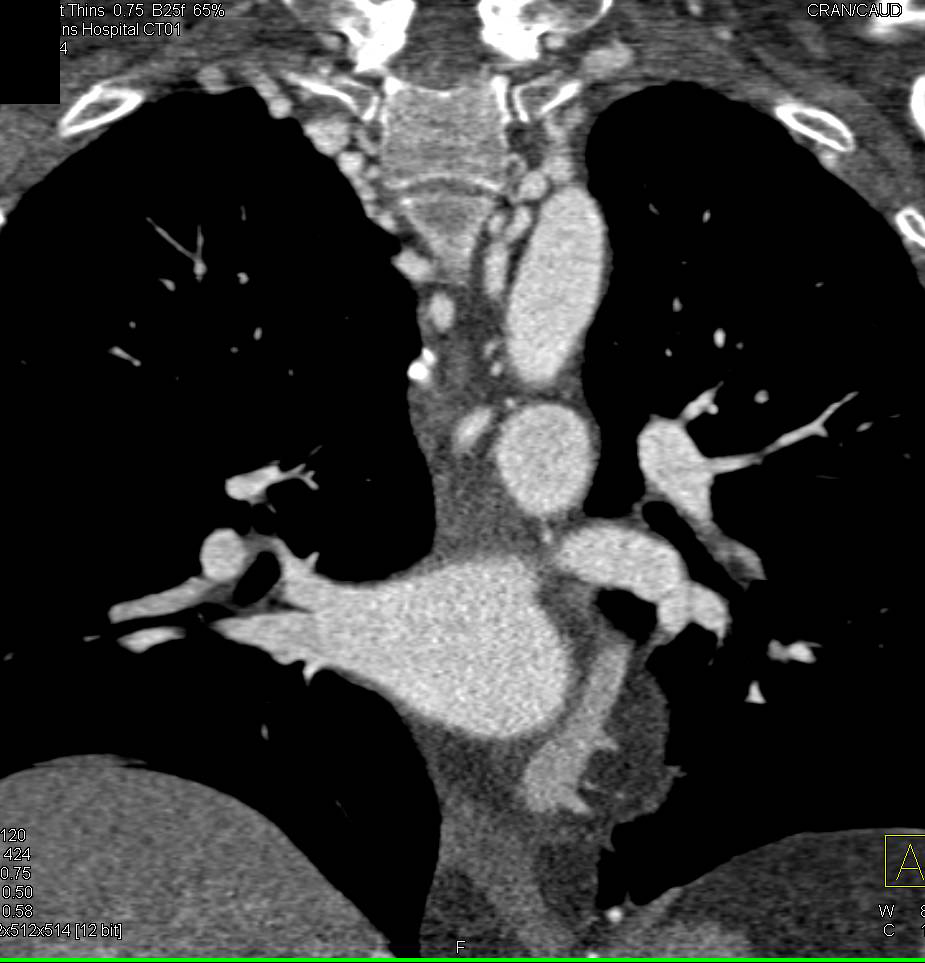 Coarctation of the Aorta with Impressive Collaterals - CTisus CT Scan