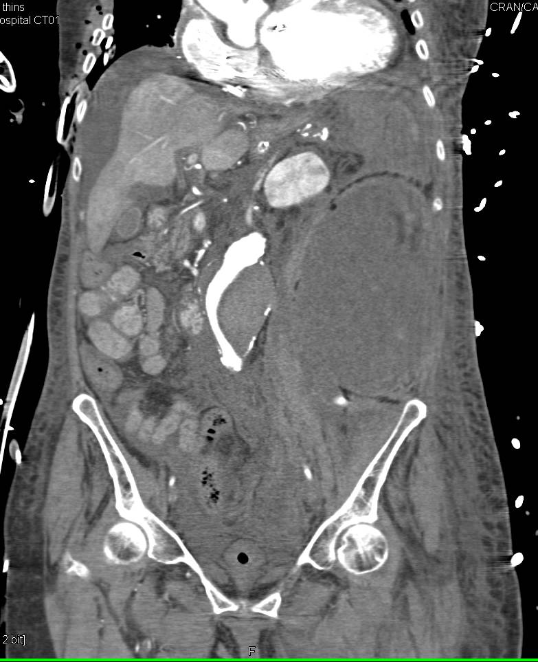 Active Extravasation of Contrast Into Retroperitoneum - CTisus CT Scan