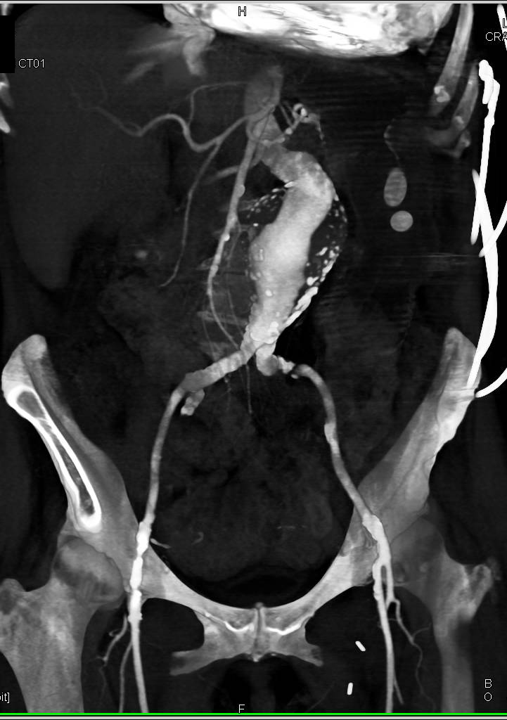 Large Retroperitoneal Bleed - CTisus CT Scan