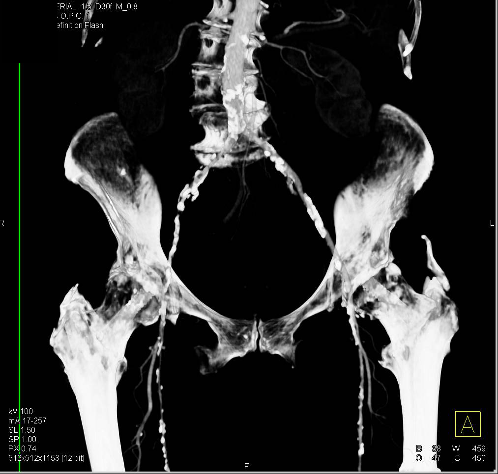 DE CTA with Peripheral vascular Disease - CTisus CT Scan