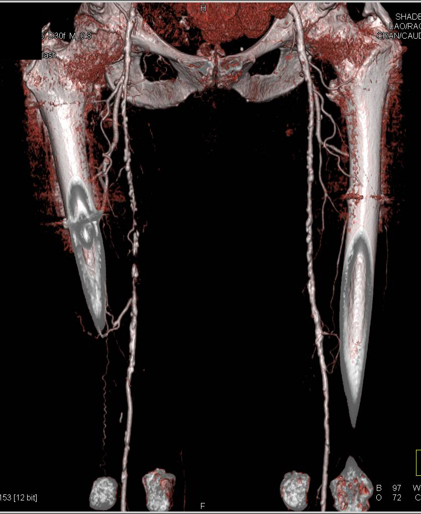 DE Runoff with Peripheral Vascular Disease - CTisus CT Scan