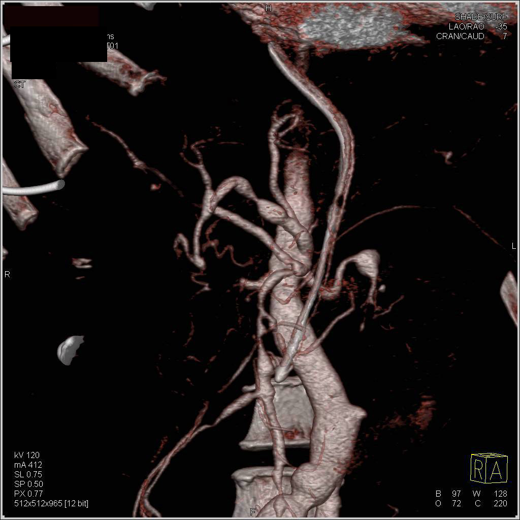 Vasculitis with Celia, SMA, Hepatic Artery Aneurysms. Venous Phase was Critical - CTisus CT Scan