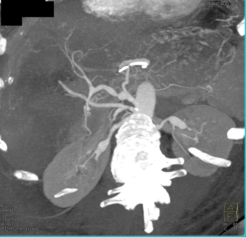 Multiple Mesenteric and Renal Artery Aneurysms in a Patient with Vasculitis and Ischemic Right Colon - CTisus CT Scan