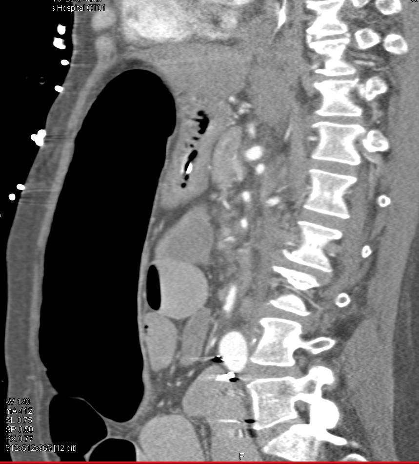 Ehlers-Danlos Syndrome with Multiple Aneurysms - CTisus CT Scan