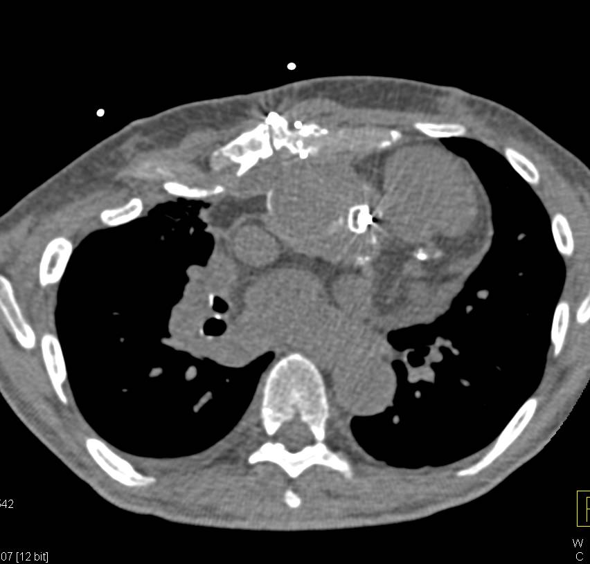 Post Operative CTA with No Complication Noted - CTisus CT Scan