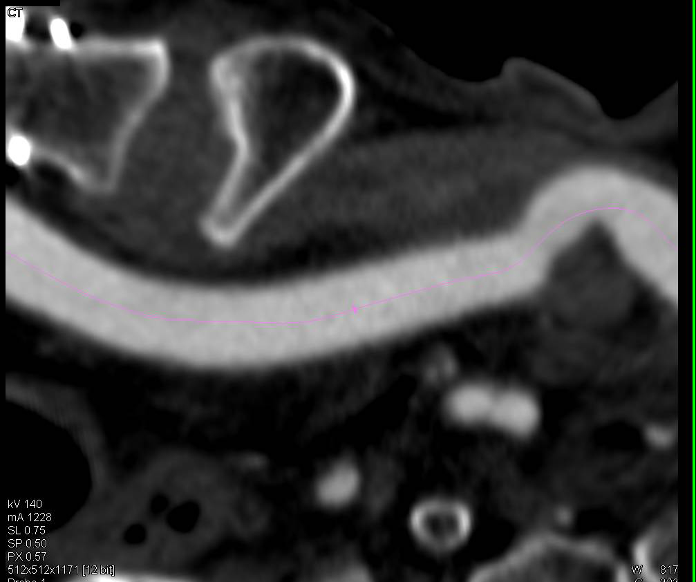 Endovascular Stent Repair of Ulcerating Plaque in Thoracic Aorta - CTisus CT Scan