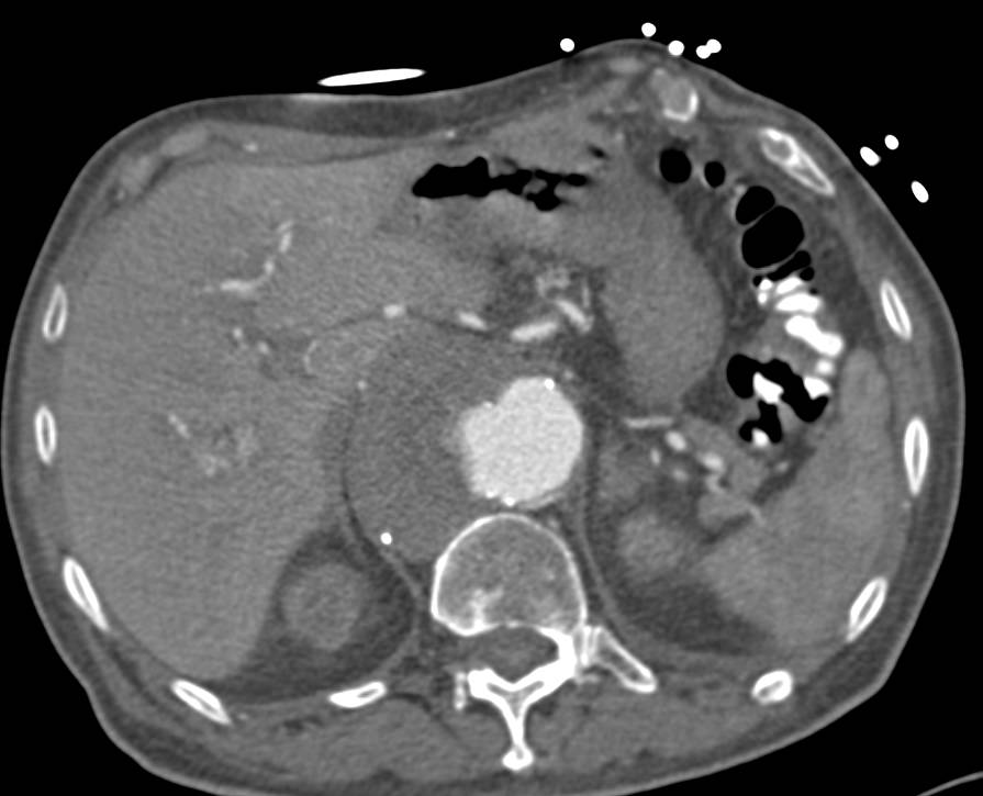 Aortic Aneurysm with Multiple Ulcerations - CTisus CT Scan