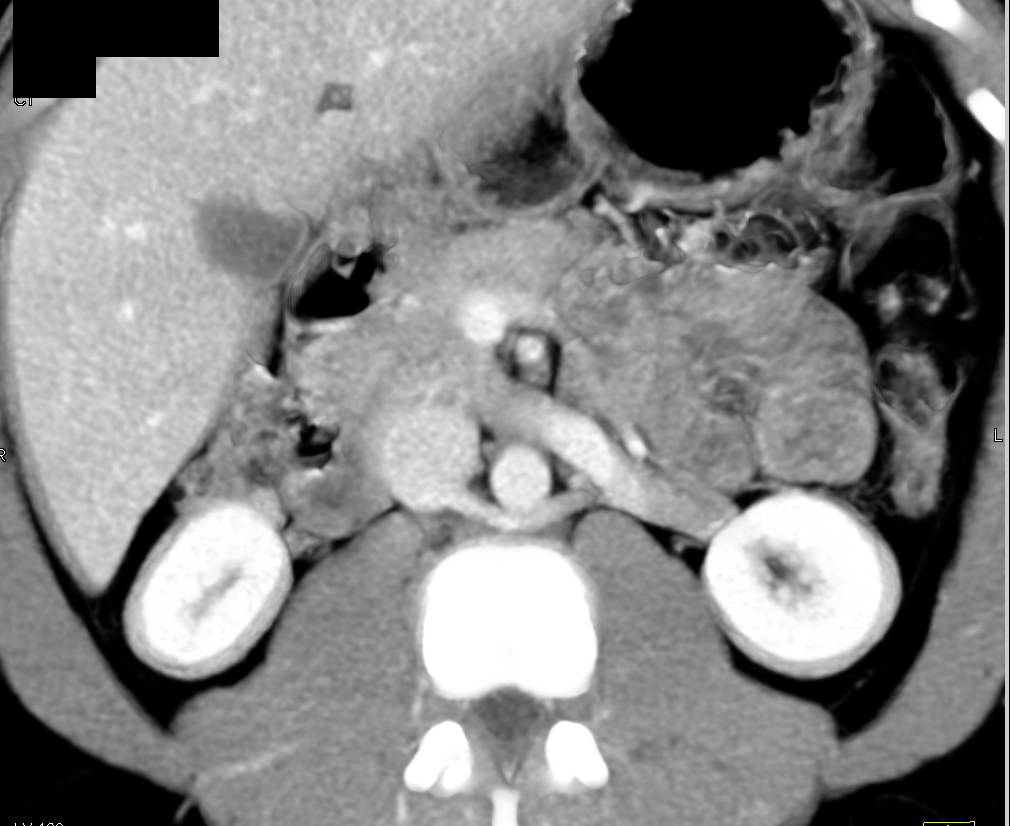 Patent Celiac Artery Stent - CTisus CT Scan