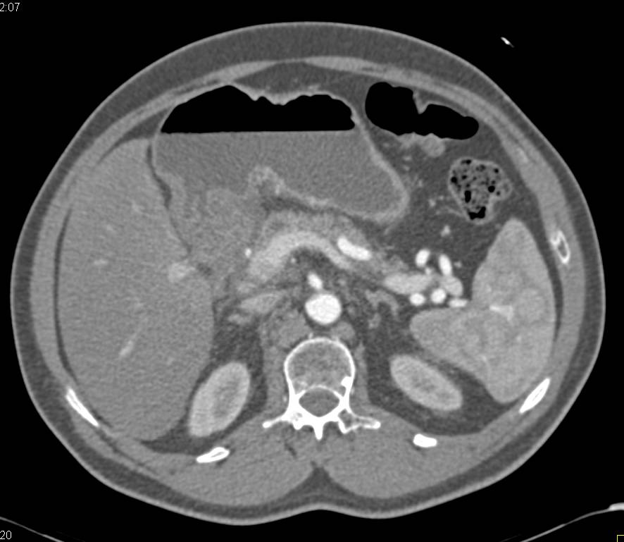 Inferior Vena Cava (IVC) Thrombus in a Patient with Pancreatic Cancer - CTisus CT Scan