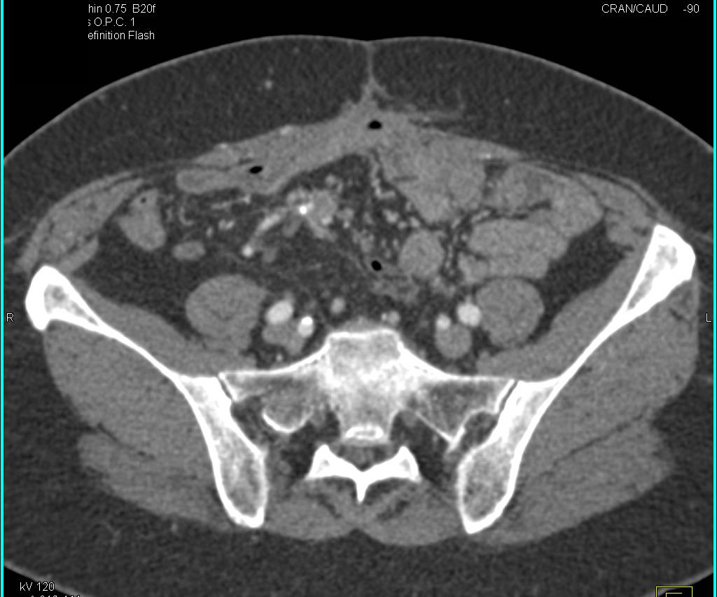 Thickening Around SMA - CTisus CT Scan