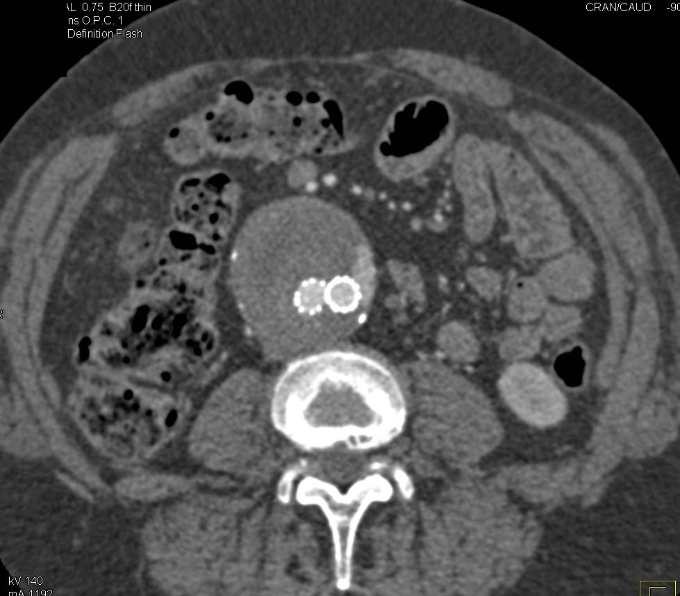 Endovascular Stent with Endoleak - CTisus CT Scan