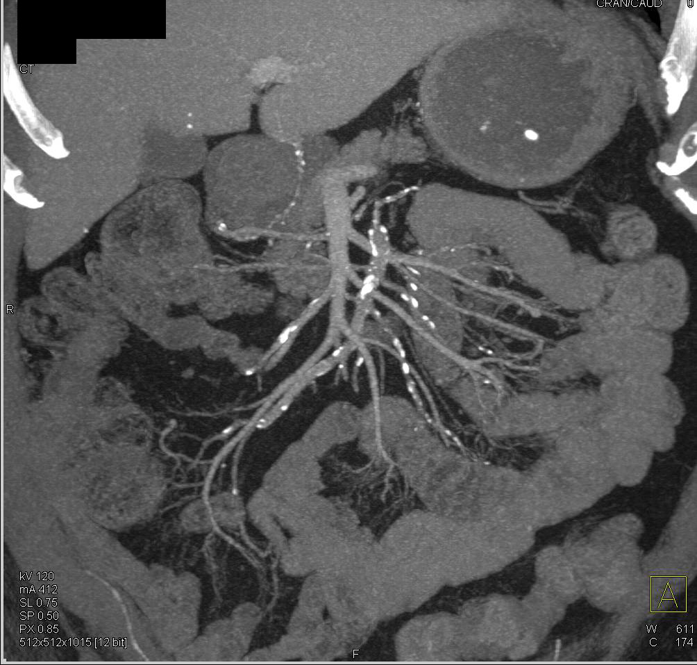 Extensive Vascular Calcification in the SMA - CTisus CT Scan