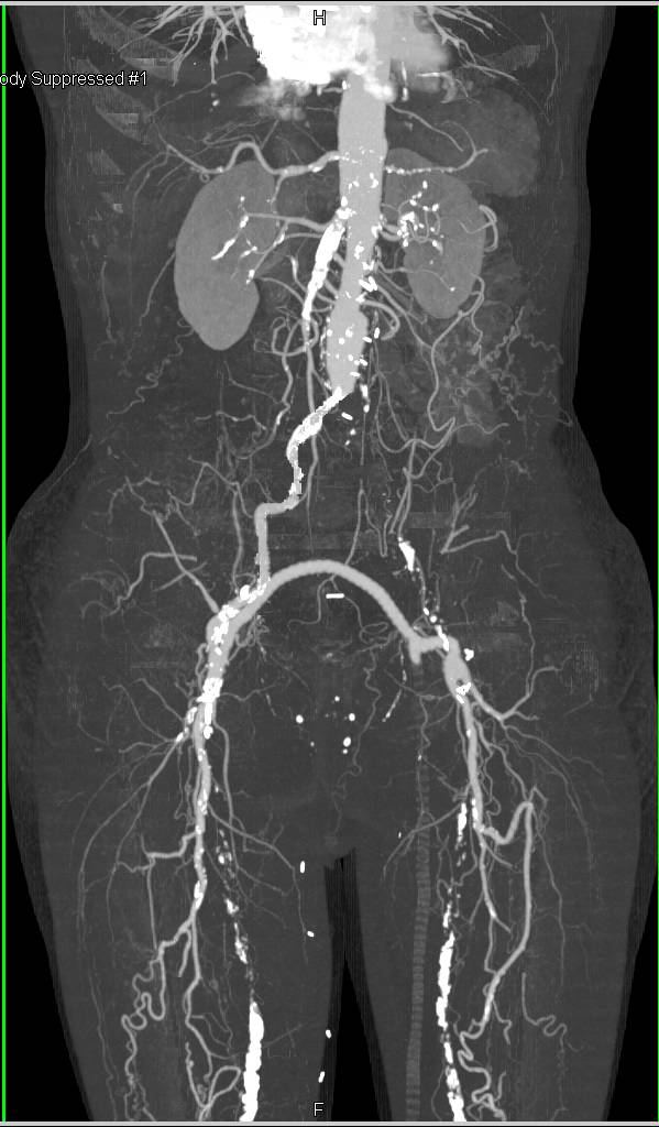 CTA with Severe Peripheral Vascular Disease and Fem-Fem Bypass which is Patent - CTisus CT Scan