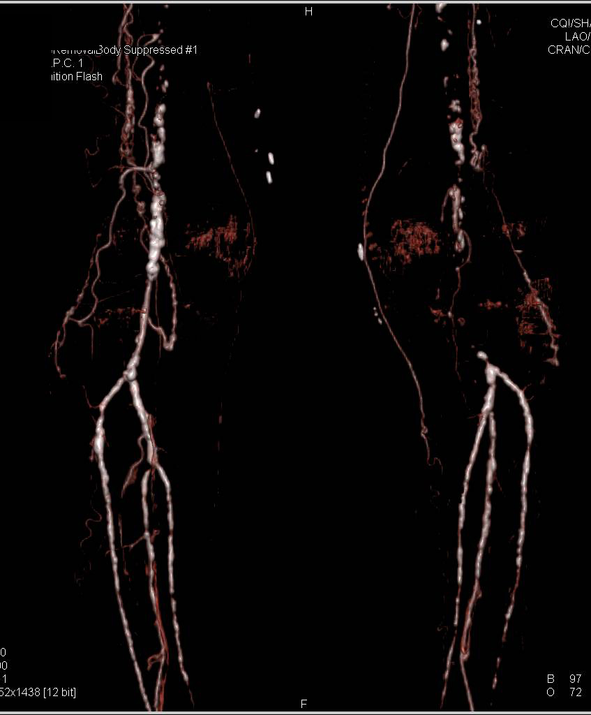 CTA DE Left Common Iliac Occlusion with Fem-Fem Bypass and Severe Peripheral Vascular Disease (PVD) - CTisus CT Scan