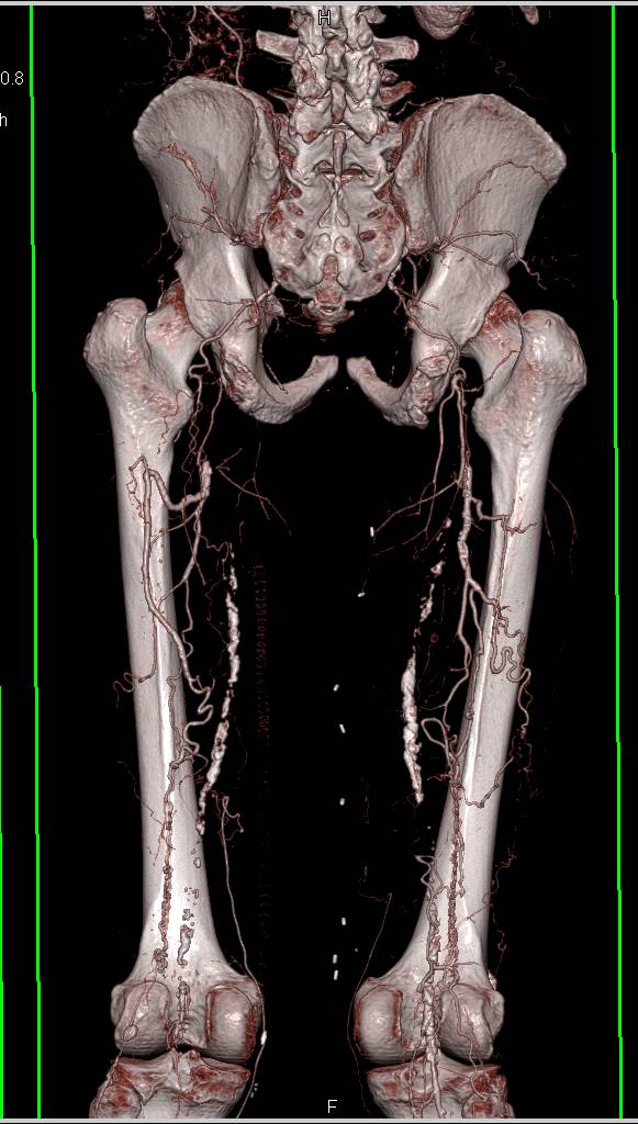 CTA Ruoff with Automated Bone Removal and Peripheral Vascular Disease (PVD) with Failed Grafts - CTisus CT Scan