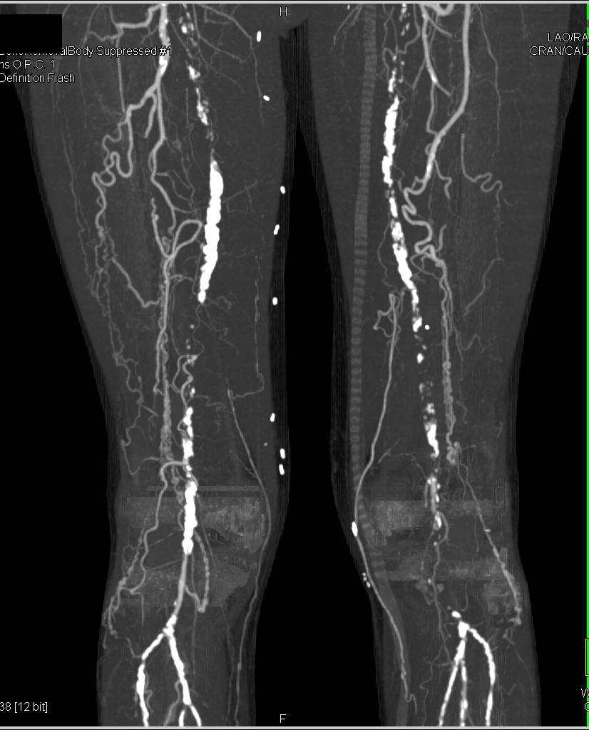 CTA Runoff with Peripheral Vascular Disease (PVD) and Grafts - CTisus CT Scan