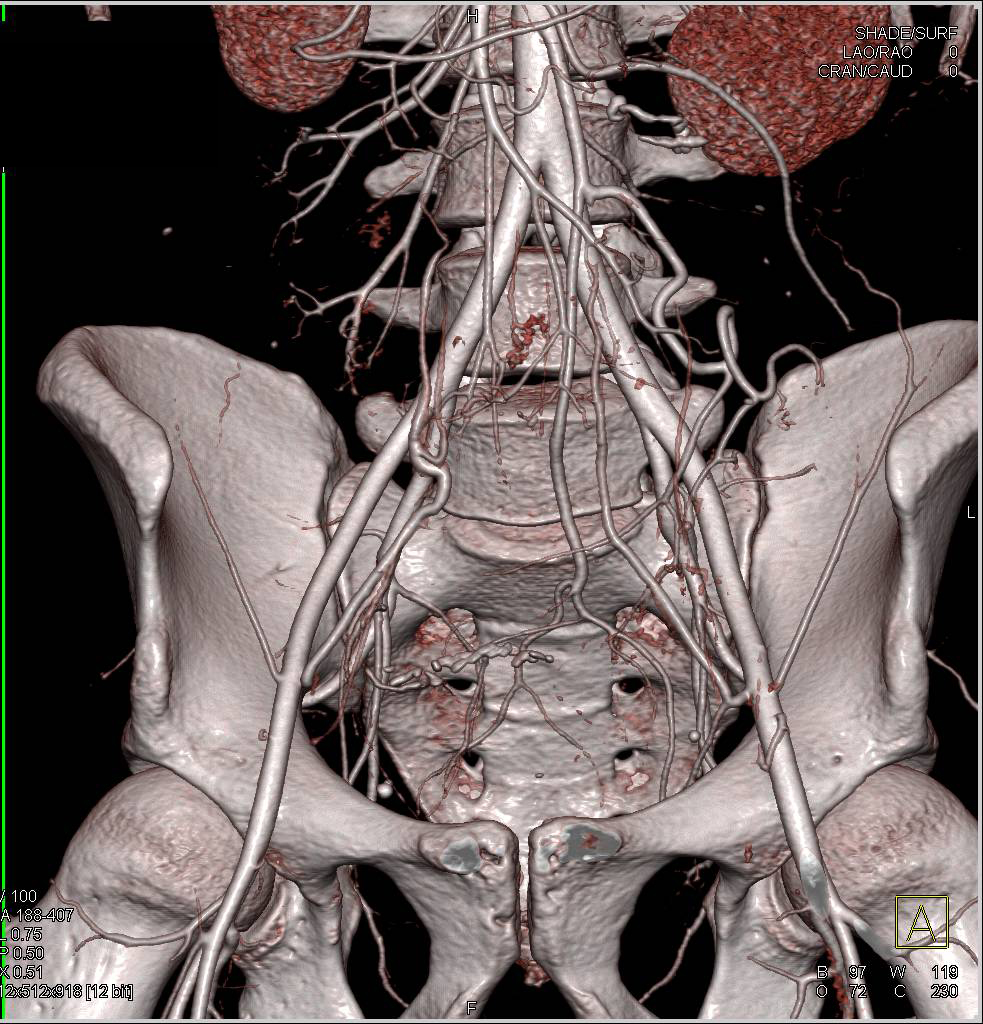 CTA Pelvis without Complication - CTisus CT Scan