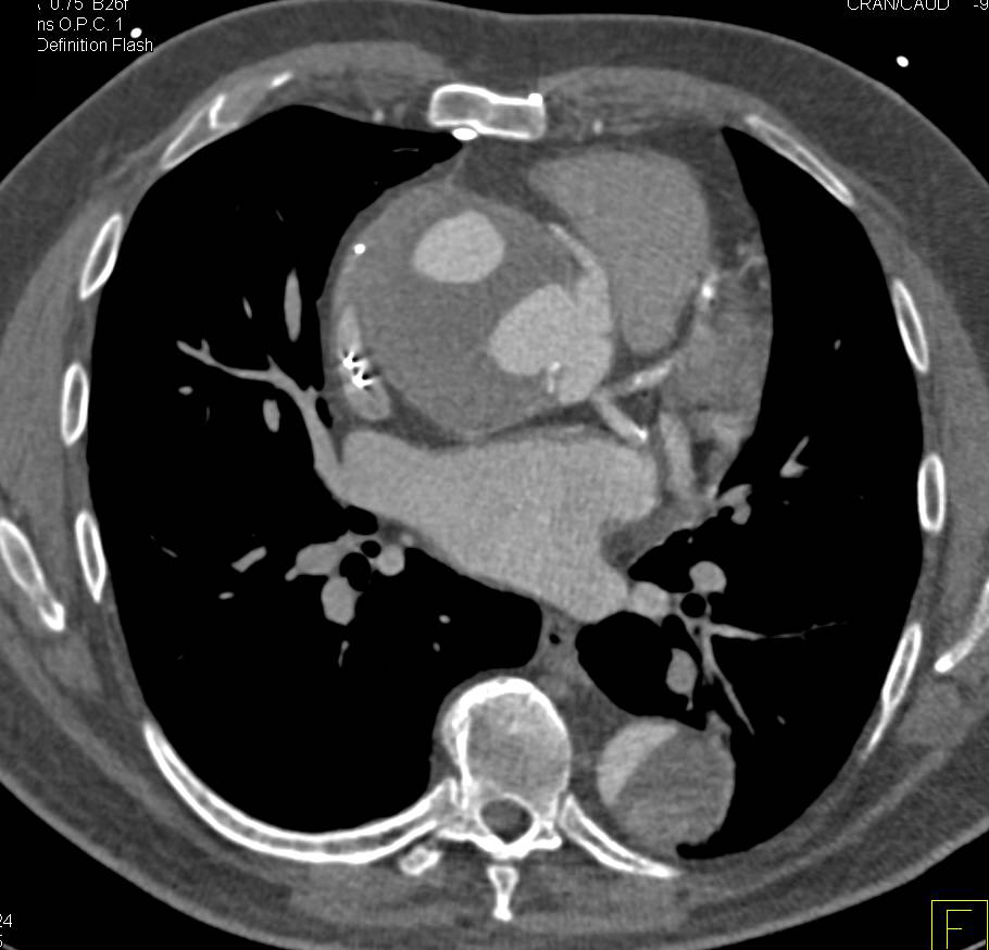 Type A Dissection with 3D Maps - CTisus CT Scan